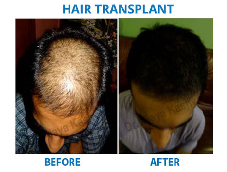 hair transplant surgery india
