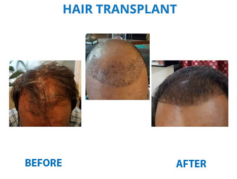 hair transplant clinic in south delhi