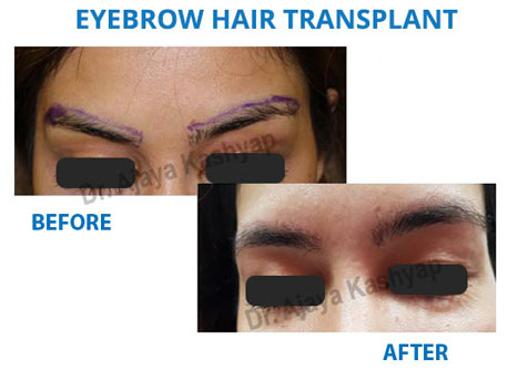 eyebrow hair transplant surgery in delhi