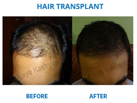 hair transplantation cost in india