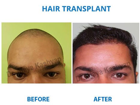 hair transplant cost in india