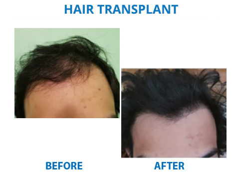 hair transplantation surgery in delhi