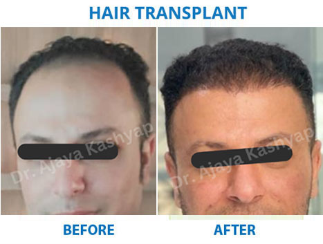 hair loss treatment cost in delhi